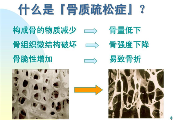 骨質疏松怎么治療？有哪些行為有害骨健康